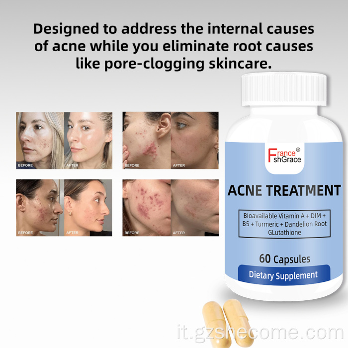 Shecome Capsule per l'acne Supporto per la salute della pelle